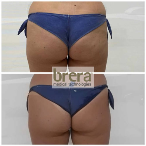 GLUTEOS ANTES-DESPUES